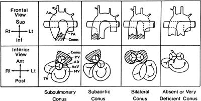 Double outlet right ventricle